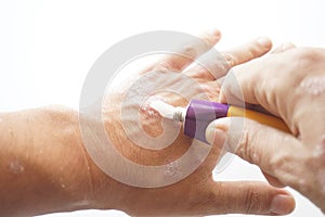 Patient squeezes out of aluminum tubes ointment with medicinal substance on finger. Photo of use of drug in form of ointments for