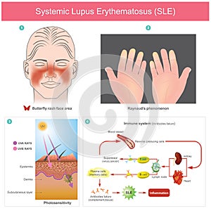 Systemic Lupus Erythematosus SLE. The patients skin inflammation from the light. Illustration. photo