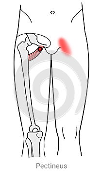 Pectineus muscle myofascial trigger points and groin pain.