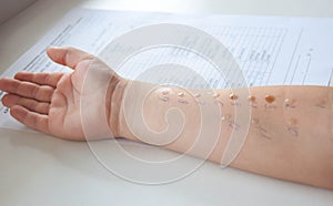 Pediatric allergy skin test