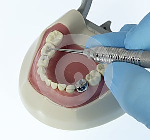 Pediatric dental filling photo