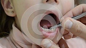 The pediatric dentist with tweezers sways the babyâ€™s milk tooth that staggers and will fall out