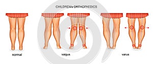 Pediatric orthopedics. valgus and varus photo