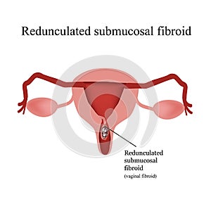 Pedunculated submucous uterine fibroids. Vaginal fibroids. Infographics. Vector illustration on background