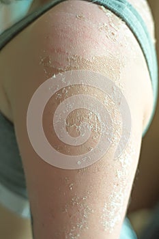 Peeling skin from a bad tan on the arm and forearm, back of the girl causes severe itching