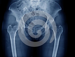 Pelvic bone x-ray