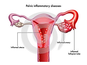 Pelvic inflammatory disease illustration photo