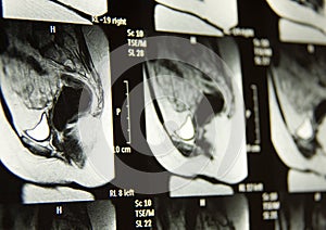 Pelvic MRI