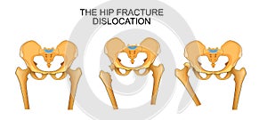 Pelvis, hip fracture. hip dislocation