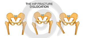 Pelvis, hip fracture. hip dislocation photo