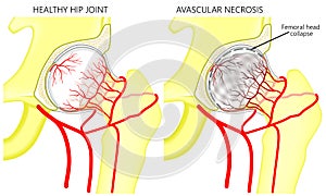 Pelvis and Hip joint problem_Avascular necrosis of the femoral h photo