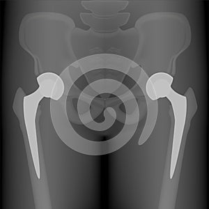 Pelvis and Hip joint problem_Bilateral hip replacement