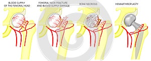 Pelvis and Hip joint problem_Femoral neck fracture and hemiarthroplasty