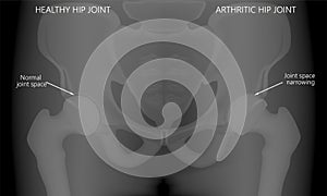 Pelvis and Hip joint problem_Pelvis Healthy and arthritic hip joints photo