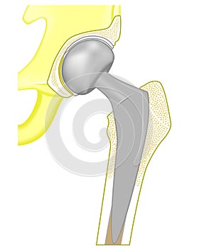 Pelvis and Hip joint problem_Hemiarthroplasty