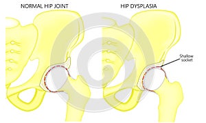 Pelvis and Hip joint problem_Hip dysplasia photo