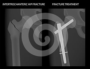 Pelvis and Hip joint problem_Intertrochanteric hip fracture treatment 1