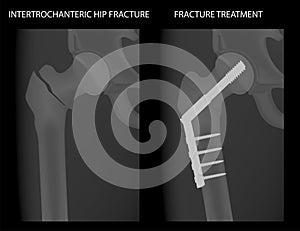 Pelvis and Hip joint problem_Intertrochanteric hip fracture treatment 2