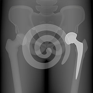 Pelvis and Hip joint problem_Total hip replacement