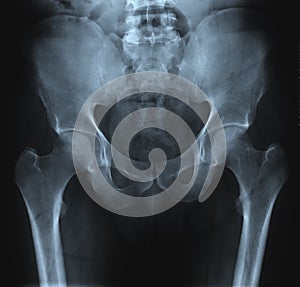 Pelvis radiograph