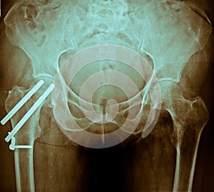 Pelvis X Ray