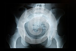 Pelvis X-ray