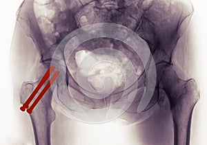 Pelvis x-ray, repair of hip fracture