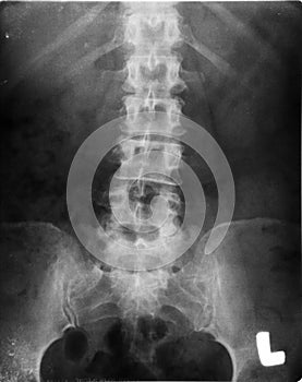 pelvis xray (x-ray)