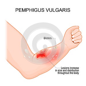 Pemphigus vulgaris. Arm with Blisters