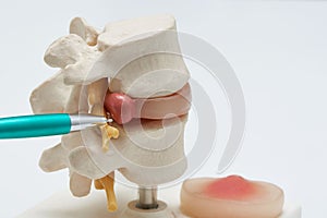 A pen pointing at herniated lumbar disc model