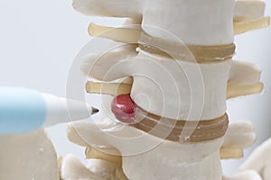 A pen pointing at herniated lumbar disc model photo