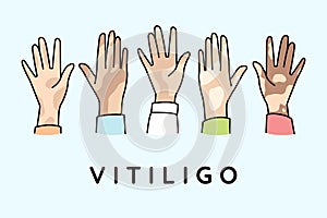 People hands with vitiligo