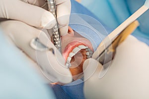 People, medicine, stomatology and dentistry concept - close up of patient face having teeth treatment at dental clinic