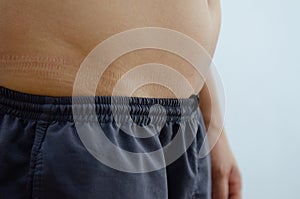 People unhealty with belly fat photo