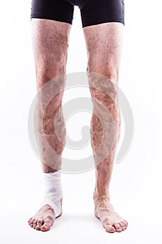 People with varicose veins of the lower extremities and venous t