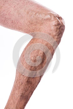 People with varicose veins of the lower extremities and venous t