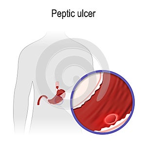 Peptic ulcer