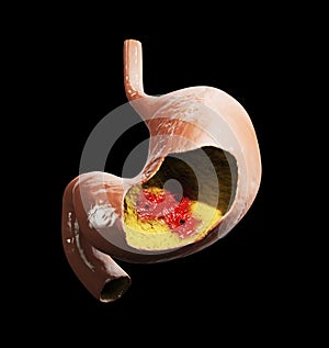 Peptic ulcer. 3d illustration of human stomach anatomy