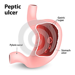 Peptic ulcer