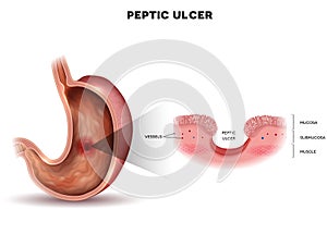 Peptic ulcer