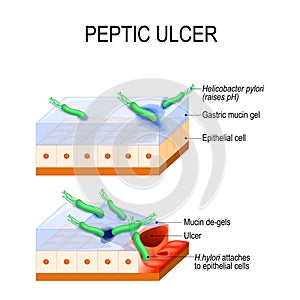 Peptic ulcer and bacterial infection. Helicobacter Pylori photo