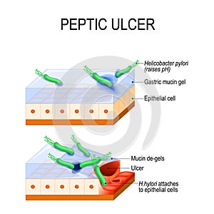 Peptic ulcer and bacterial infection. Helicobacter Pylori