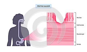 Peptic ulcer disease