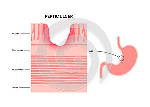 Peptic ulcer disease