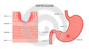 Peptic ulcer disease