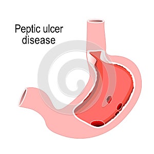 Peptic ulcer disease. Cross section of the humans stomach photo