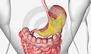 Peptic ulcer disease, is the formation of ulcers in the lining of the stomach and first section of the small intestine