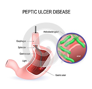 Peptic ulcer disease PUD, stomach ulcer or gastric ulcer photo