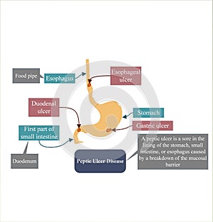 Peptic ulcer disease relates to ulcer