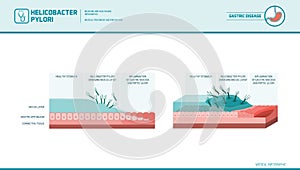 Peptic ulcer and helicobacter pylori photo